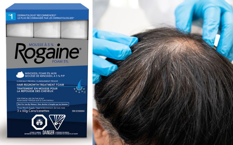 You are currently viewing Minoxidil 5% : Tout ce que tu dois savoir sur ce traitement anti-chute