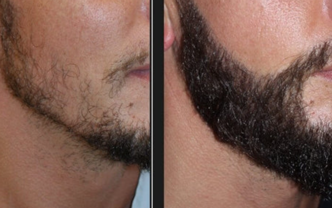 Avant et après l'utilisation de minoxidil sur la barbe