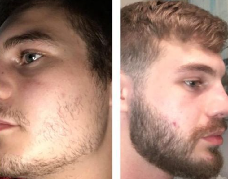 Avant et après l'utilisation de minoxidil sur la barbe