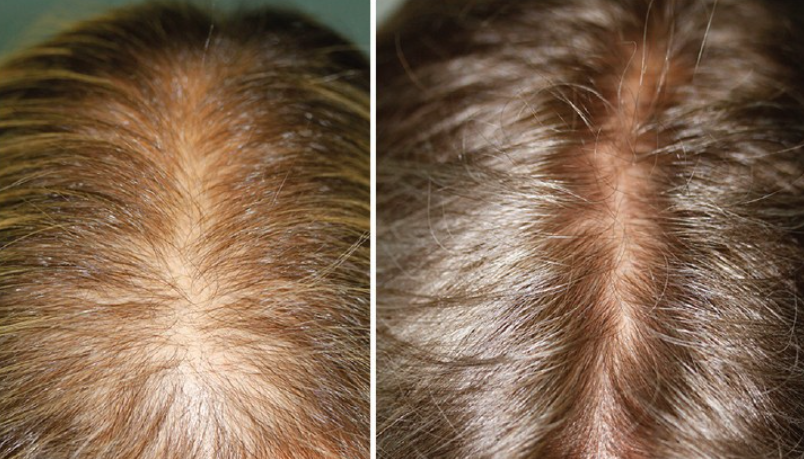 Comment fonctionne le Minoxidil 5% ?