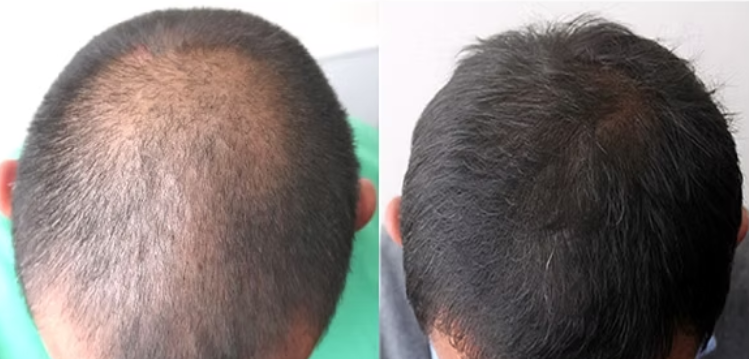 Les avis sur le Minoxidil 5% sont généralement positifs